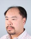 Before Hair Transplant&nbsp;Front
